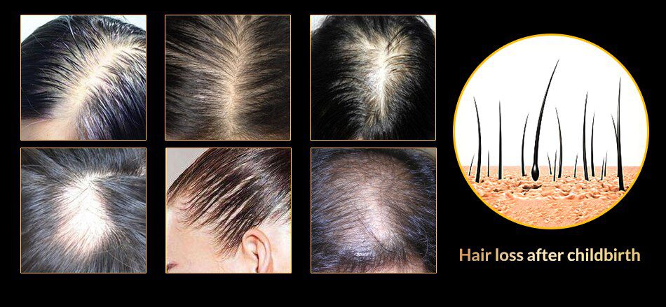 OMY LADY Anti Hair Loss Hair Growth Spray Essential Oil Liquid For Men Women Dry Hair Regeneration Repair,Hair Loss Products OMY LADY Anti Hair Loss Hair Growth Spray Essential Oil Liquid For Men Women Dry Hair Regeneration Repair,Hair Loss Products