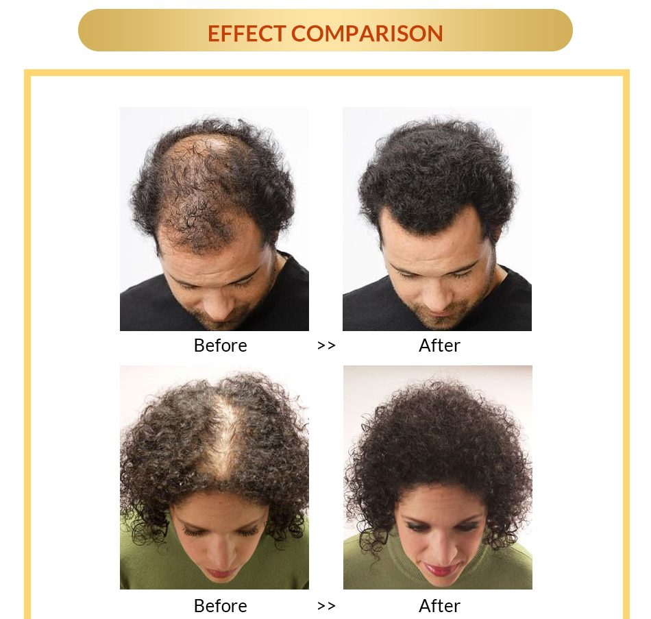 OMY LADY Anti Hair Loss Hair Growth Spray Essential Oil Liquid For Men Women Dry Hair Regeneration Repair,Hair Loss Products OMY LADY Anti Hair Loss Hair Growth Spray Essential Oil Liquid For Men Women Dry Hair Regeneration Repair,Hair Loss Products