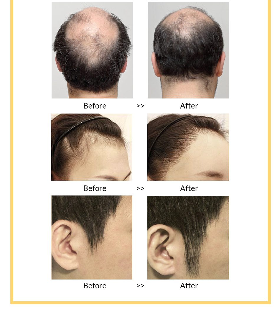 OMY LADY Anti Hair Loss Hair Growth Spray Essential Oil Liquid For Men Women Dry Hair Regeneration Repair,Hair Loss Products OMY LADY Anti Hair Loss Hair Growth Spray Essential Oil Liquid For Men Women Dry Hair Regeneration Repair,Hair Loss Products