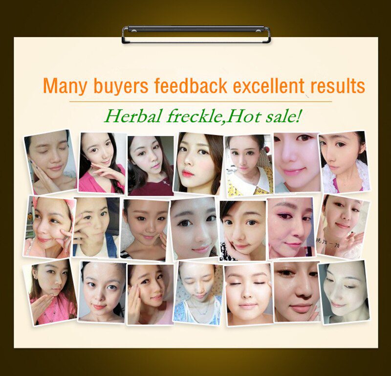 Dimollaure Kojic acid Whitening Cream Retinol Vitamin A serum Remove Freckle melasma pigment Melanin Acne scar dark Spots Dimollaure Kojic acid Whitening Cream Retinol Vitamin A serum Remove Freckle melasma pigment Melanin Acne scar dark Spots