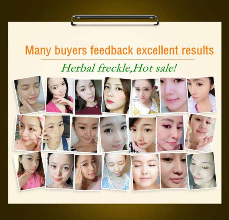 Dimollaure kojic acid Retinol whitening cream Vitamin C peptides Argireline serum Remov Freckle melasma pigment Melanin darkSpot Dimollaure kojic acid Retinol whitening cream Vitamin C peptides Argireline serum Remov Freckle melasma pigment Melanin darkSpot