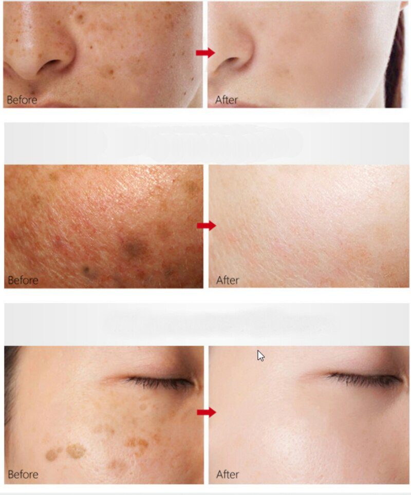 Dimollaure Retinol Cream Whitening Moisturizing kojic acid serum Remove Freckle melasma Melanin sunburn Acne scar dark Spot Dimollaure Retinol Cream Whitening Moisturizing kojic acid serum Remove Freckle melasma Melanin sunburn Acne scar dark Spot