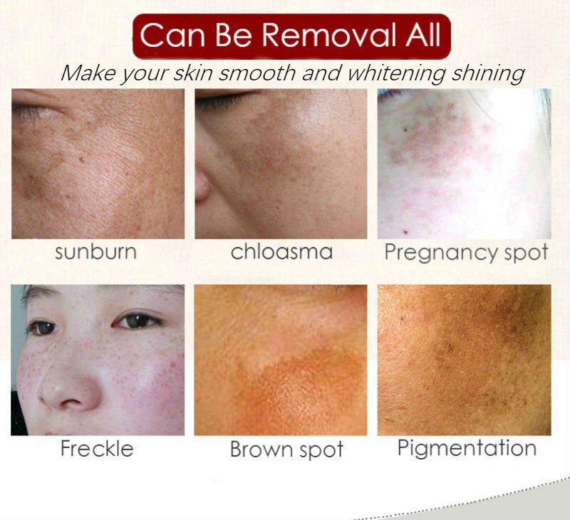 Dimollaure Retinol Cream Whitening Moisturizing kojic acid serum Remove Freckle melasma Melanin sunburn Acne scar dark Spot Dimollaure Retinol Cream Whitening Moisturizing kojic acid serum Remove Freckle melasma Melanin sunburn Acne scar dark Spot