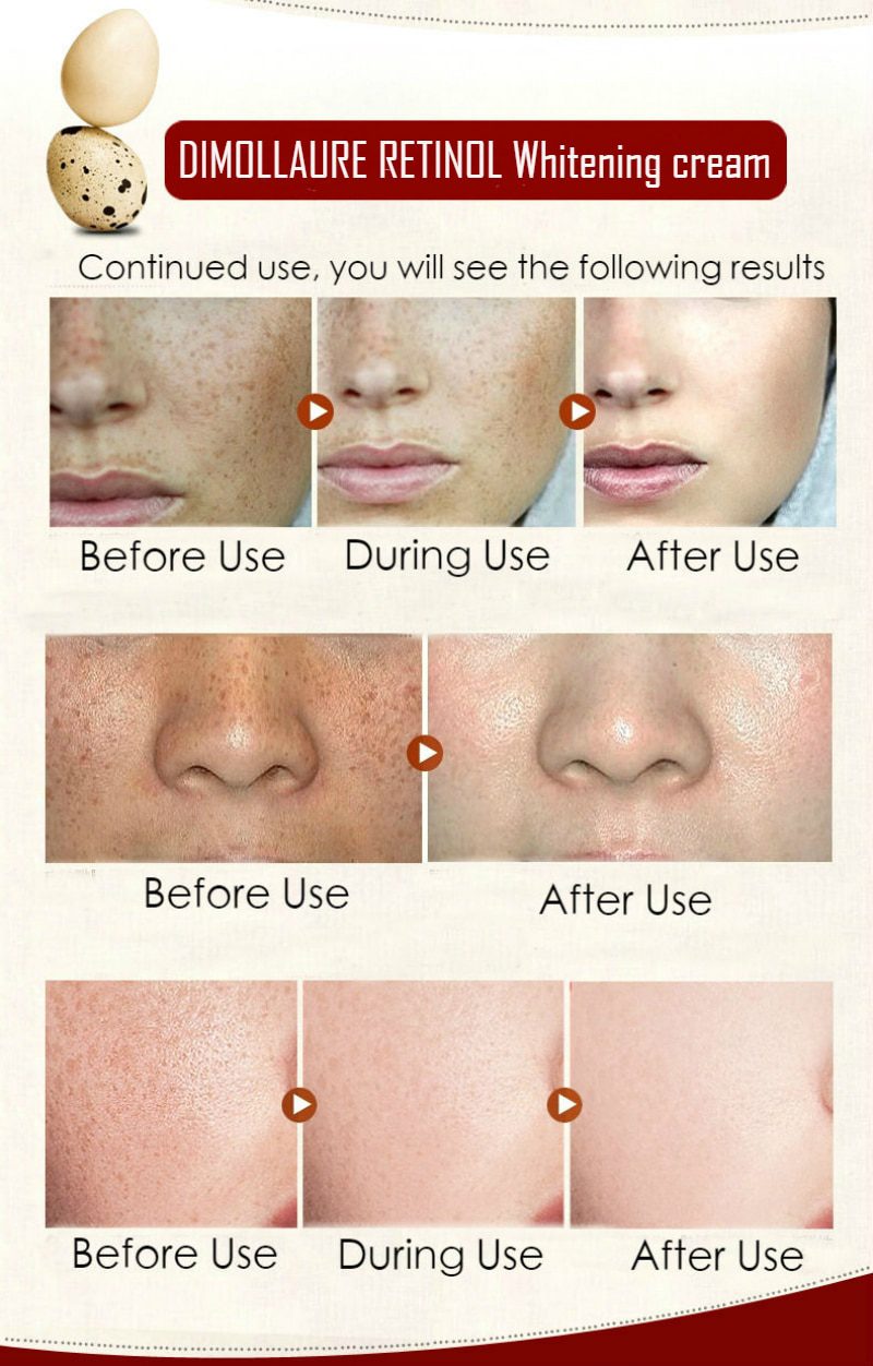Dimollaure Retinol Cream Whitening Moisturizing kojic acid serum Remove Freckle melasma Melanin sunburn Acne scar dark Spot Dimollaure Retinol Cream Whitening Moisturizing kojic acid serum Remove Freckle melasma Melanin sunburn Acne scar dark Spot