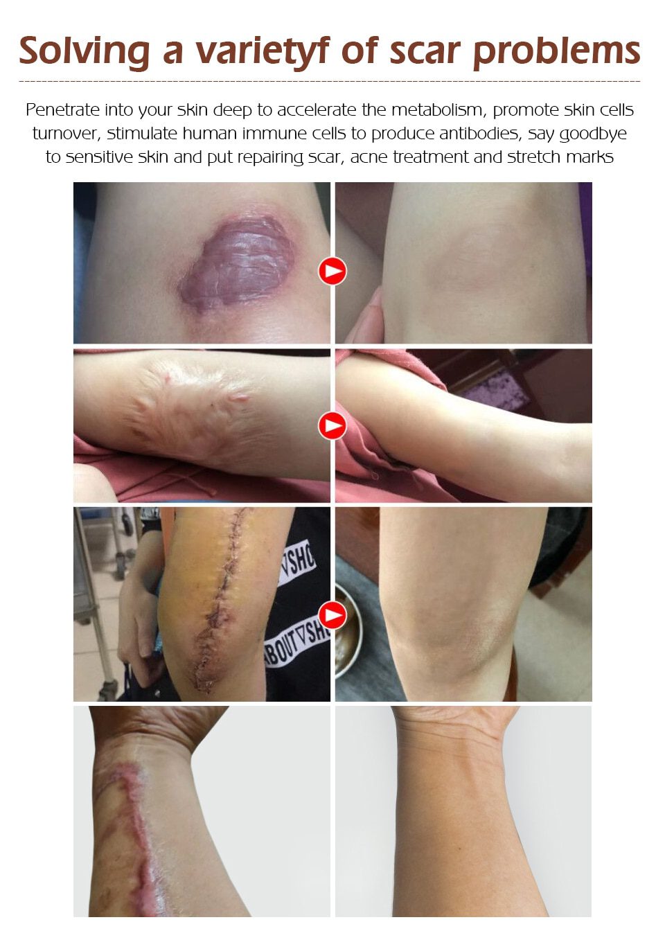 VIBRANT GLAMOUR Repair Scar Removal Cream Acne Scars Gel Stretch Marks Surgical Scar Burn For Body Pigmentation Corrector Care VIBRANT GLAMOUR Repair Scar Removal Cream Acne Scars Gel Stretch Marks Surgical Scar Burn For Body Pigmentation Corrector Care