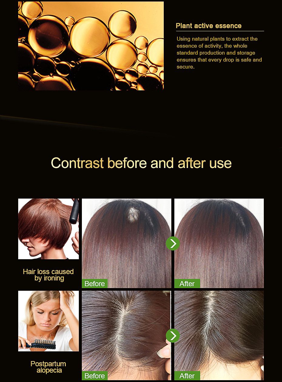 AMEIZII Andrea 20ml Ginger Extract Dense Hair Fast Sunburst Hair Growth Essence Restoration Hair Loss Liquid Serum Hair Care Oil AMEIZII Andrea 20ml Ginger Extract Dense Hair Fast Sunburst Hair Growth Essence Restoration Hair Loss Liquid Serum Hair Care Oil