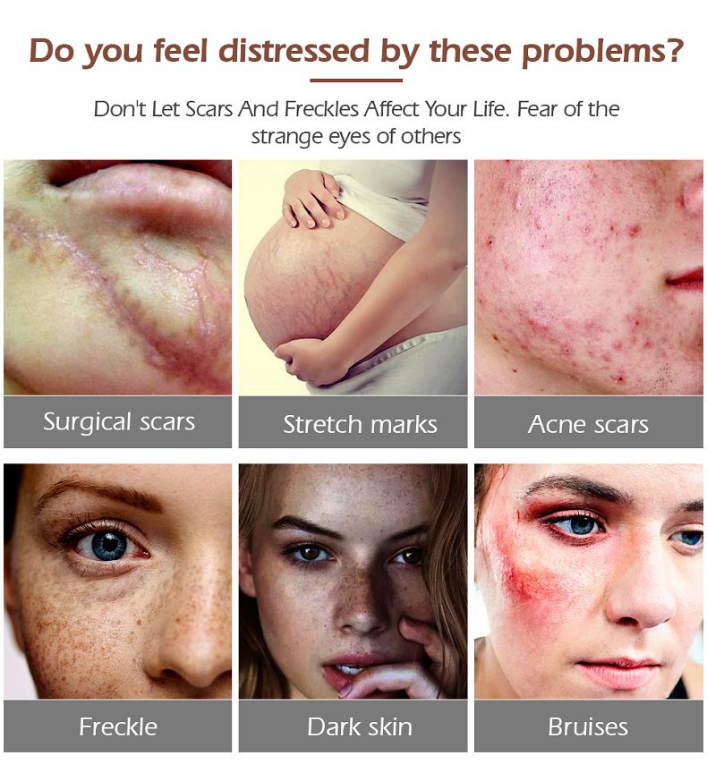 MEIKING Dark Spot Corrector Skin Whitening Fade Cream Lightening Blemish Removal Serum Reduces Age Spots Freckles Melasma Cream MEIKING Dark Spot Corrector Skin Whitening Fade Cream Lightening Blemish Removal Serum Reduces Age Spots Freckles Melasma Cream