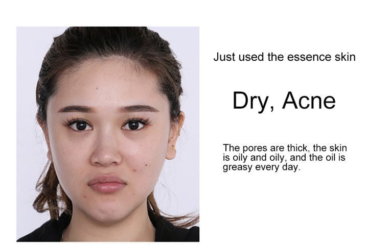 LAIKOU 24k Gold Face Serum Hyaluronic Acid Serum Moisturizer Essence Cream Whitening Day Creams Anti Aging Anti Wrinkle Acne Art LAIKOU 24k Gold Face Serum Hyaluronic Acid Serum Moisturizer Essence Cream Whitening Day Creams Anti Aging Anti Wrinkle Acne Art