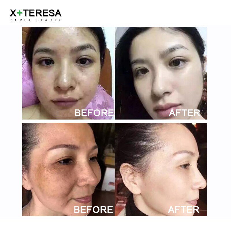 Dark Spot Corrector Whitening Serum Face Bleaching Serum Brighten Blemish Freckle Remover Natural Carrot Essence Korea Skin Care Dark Spot Corrector Whitening Serum Face Bleaching Serum Brighten Blemish Freckle Remover Natural Carrot Essence Korea Skin Care