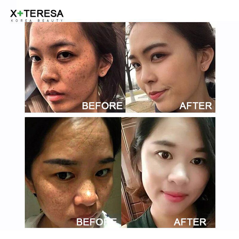Dark Spot Corrector Whitening Serum Face Bleaching Serum Brighten Blemish Freckle Remover Natural Carrot Essence Korea Skin Care Dark Spot Corrector Whitening Serum Face Bleaching Serum Brighten Blemish Freckle Remover Natural Carrot Essence Korea Skin Care