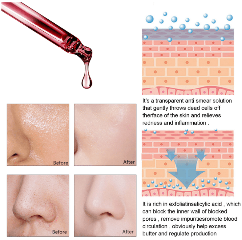 Salicylic Acid Shrink Pores Serum Fruit Acid Exfoliating Moisturizing Nourish Smooth Pores Repair Essence Products Skin Care Salicylic Acid Shrink Pores Serum Fruit Acid Exfoliating Moisturizing Nourish Smooth Pores Repair Essence Products Skin Care