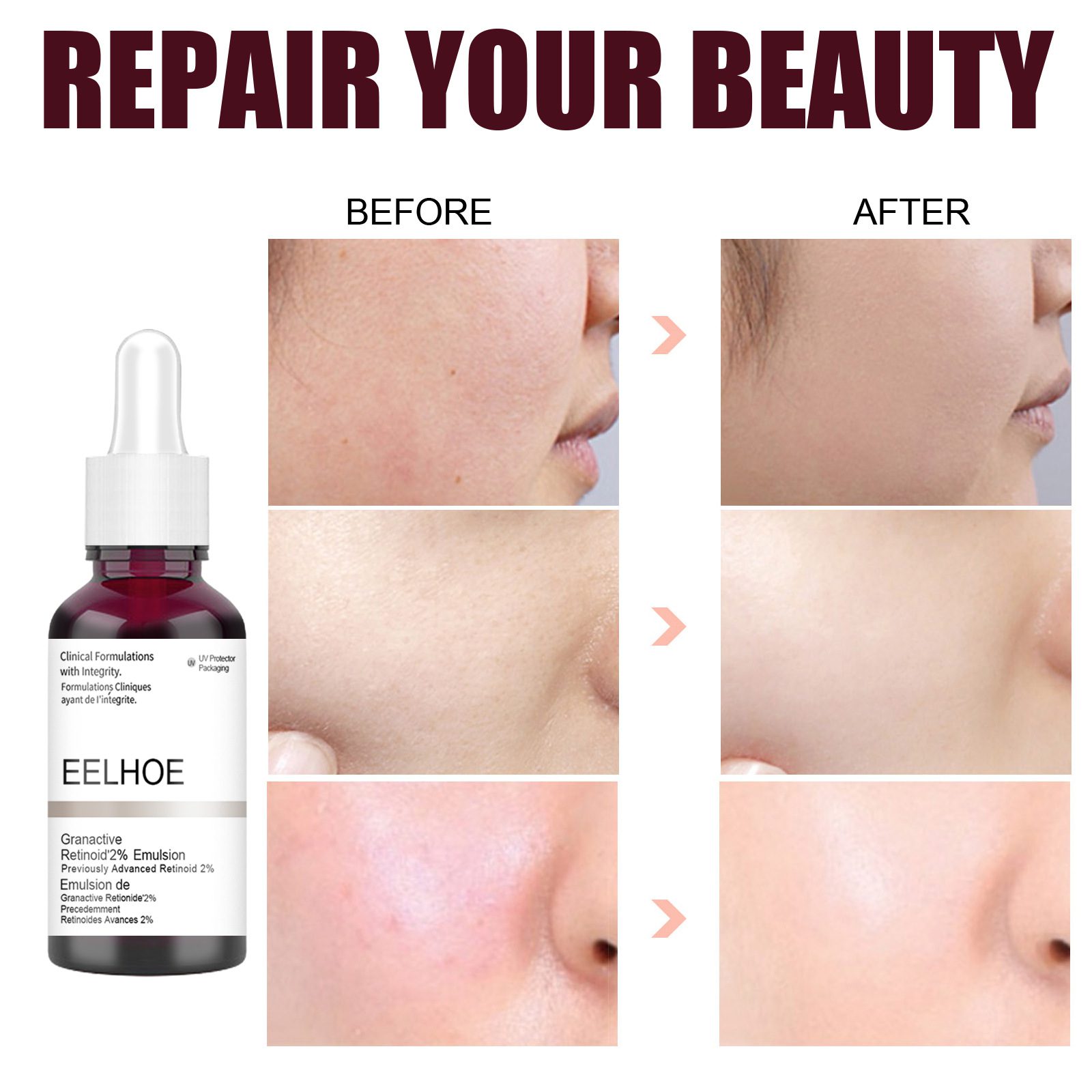 Salicylic Acid Shrink Pores Serum Fruit Acid Exfoliating Moisturizing Nourish Smooth Pores Repair Essence Products Skin Care Salicylic Acid Shrink Pores Serum Fruit Acid Exfoliating Moisturizing Nourish Smooth Pores Repair Essence Products Skin Care