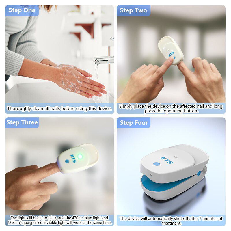 Fungal Nail Treatment Laser Device For Nail Fungus 905nm 470nm Fungus Nail Removal Anti Infection Paronychia Onychomycosis Care Fungal Nail Treatment Laser Device For Nail Fungus 905nm 470nm Fungus Nail Removal Anti Infection Paronychia Onychomycosis Care