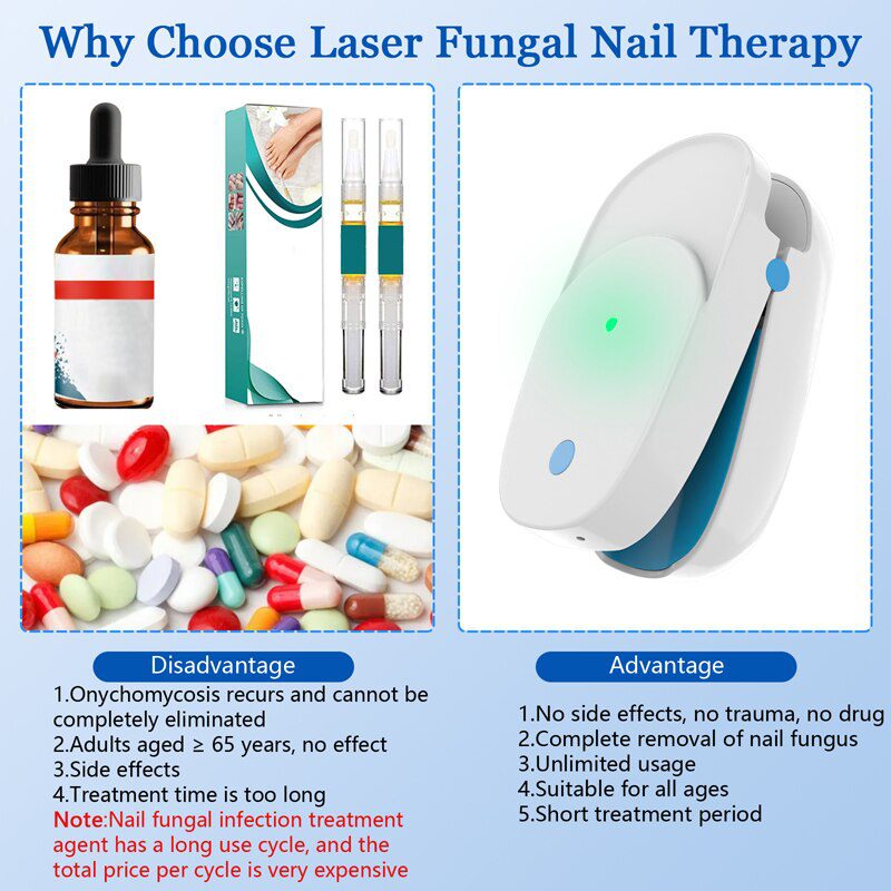 Fungal Nail Treatment Laser Device For Nail Fungus 905nm 470nm Fungus Nail Removal Anti Infection Paronychia Onychomycosis Care Fungal Nail Treatment Laser Device For Nail Fungus 905nm 470nm Fungus Nail Removal Anti Infection Paronychia Onychomycosis Care