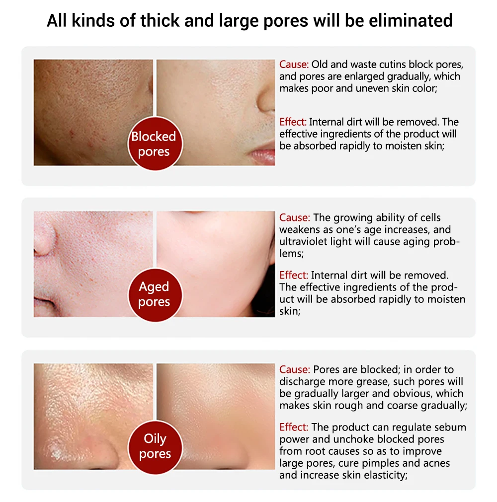 LANBENA Pore Solution Serum Shrink Pores Acne Treatment Remover Nose Blackhead Skin Firming Moisturizing Face Serum Skin Care LANBENA Pore Solution Serum Shrink Pores Acne Treatment Remover Nose Blackhead Skin Firming Moisturizing Face Serum Skin Care