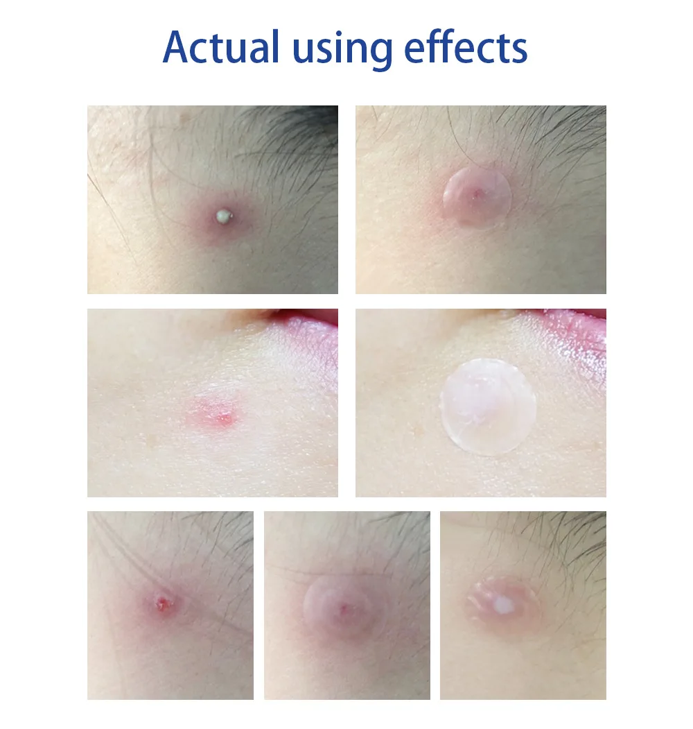 LANBENA Invisible Acne Pimple Patch Face Mask Acne Pimple Blemish Removal Stickers Acne Treatment Master Daily / Night Use LANBENA Invisible Acne Pimple Patch Face Mask Acne Pimple Blemish Removal Stickers Acne Treatment Master Daily / Night Use